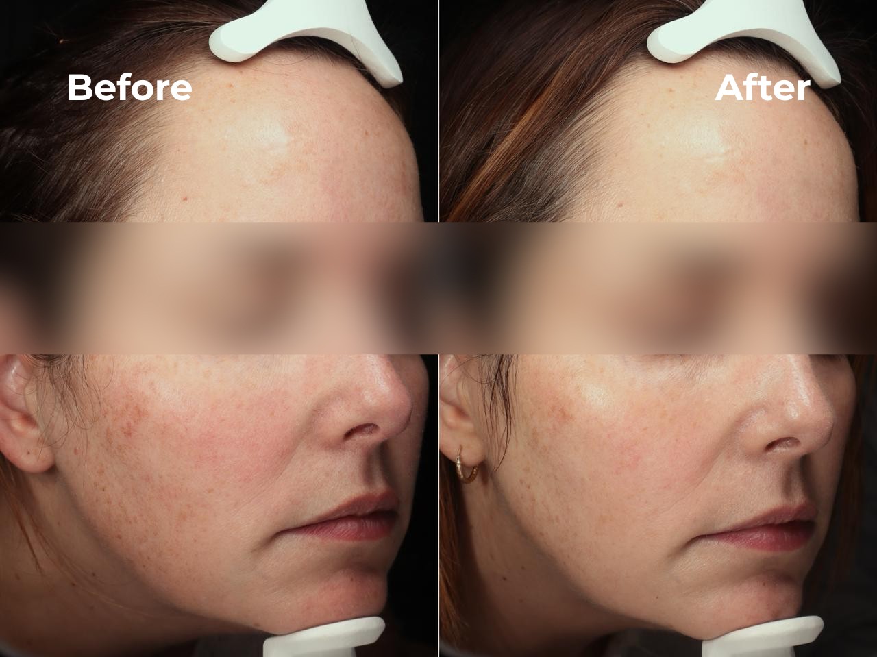 XERF Full Face before and after result 1