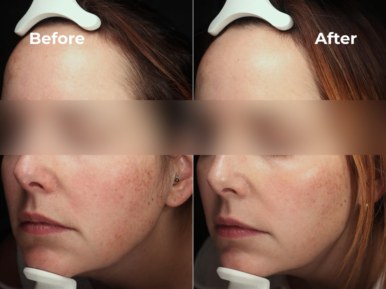 XERF Full Face before and after result 2