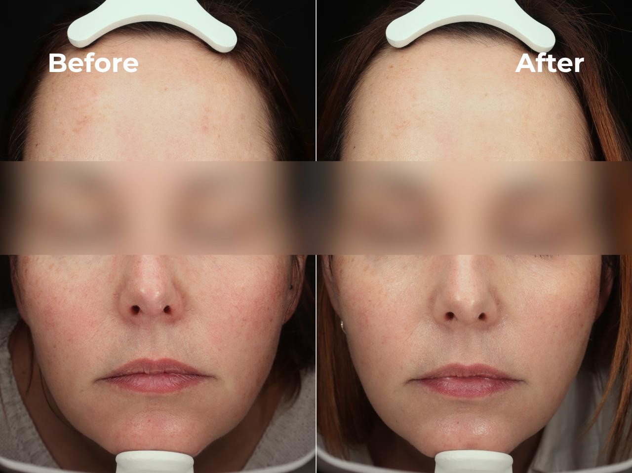 XERF Full Face before and after result 4