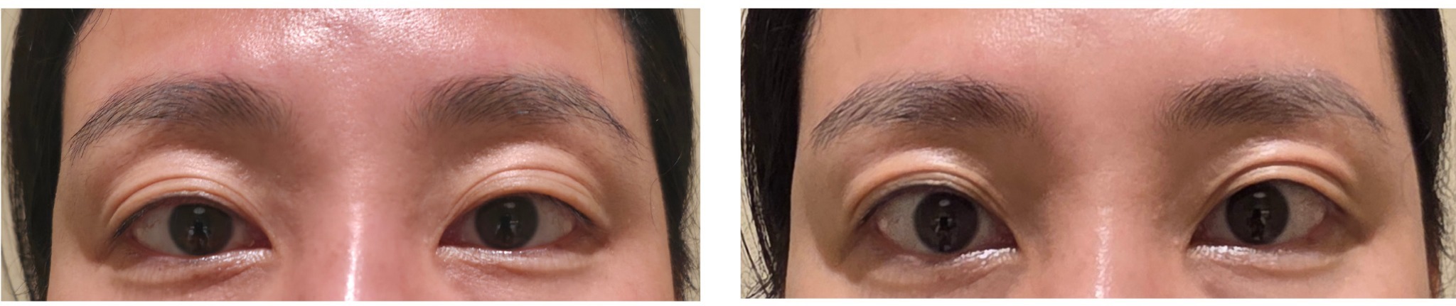 XERF Eyes before and after clinical result