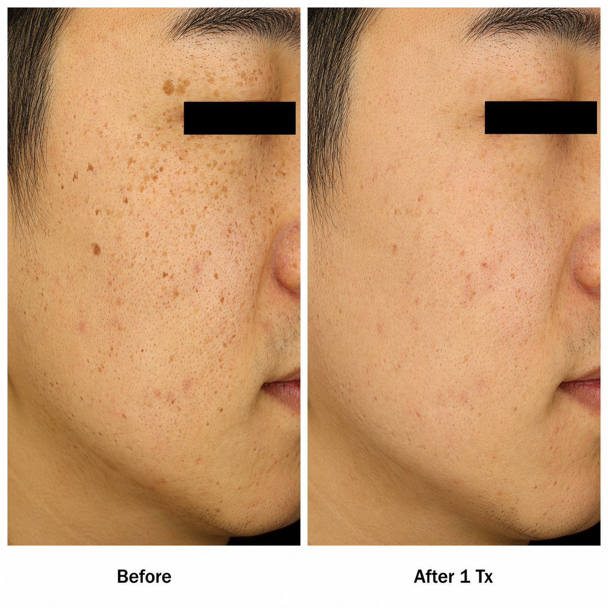 Skin Resurfacing / Rejuvenation clinical result 01