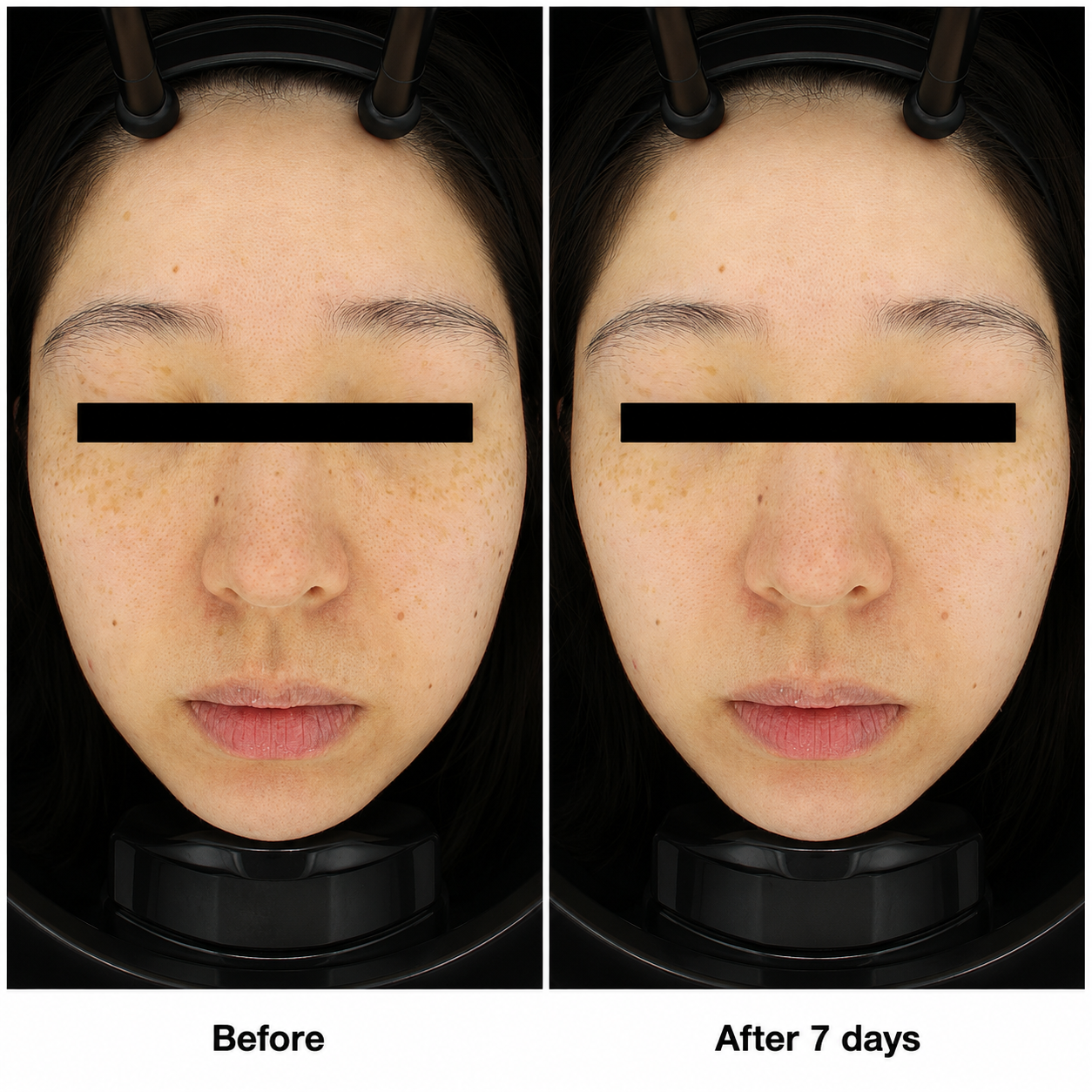 Skin Resurfacing / Rejuvenation clinical result 02