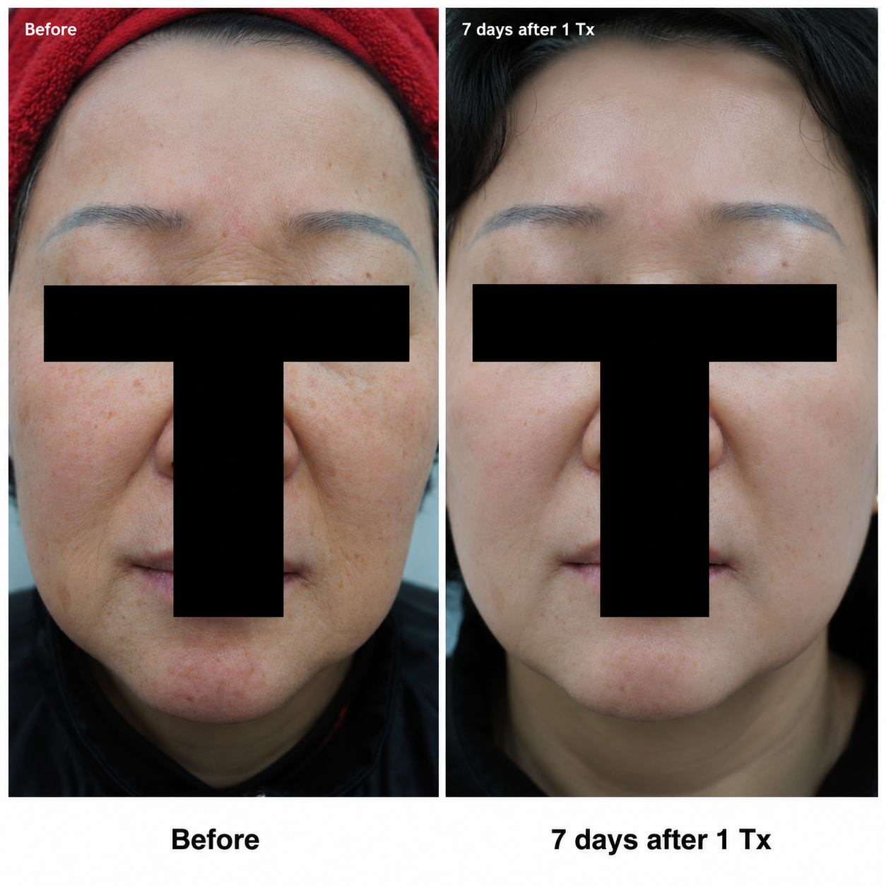 Skin Resurfacing / Rejuvenation clinical result 03