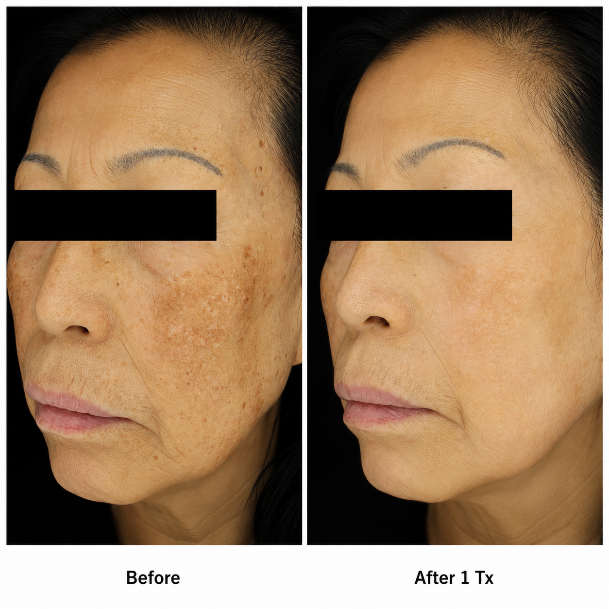 Skin Resurfacing / Rejuvenation clinical result 04