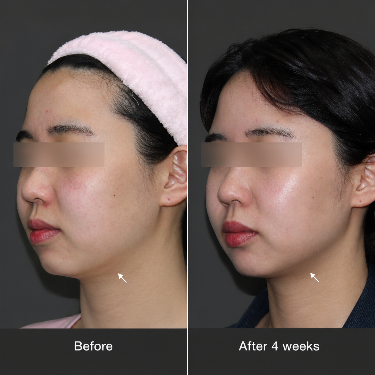Oligio X clinical result 02