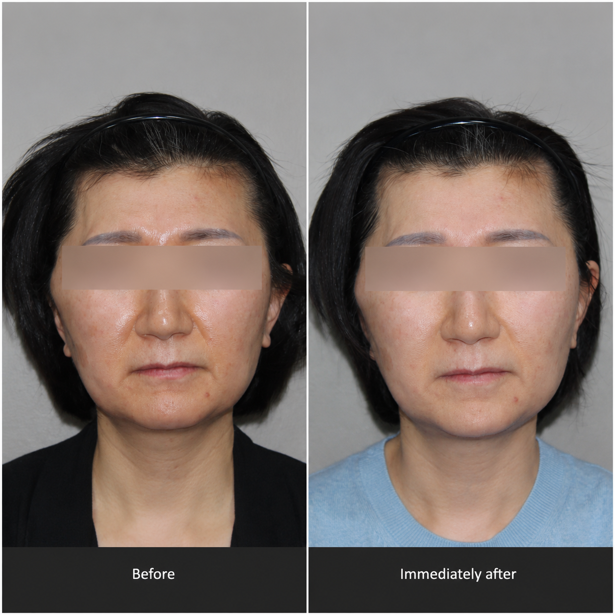 Oligio X clinical result 03