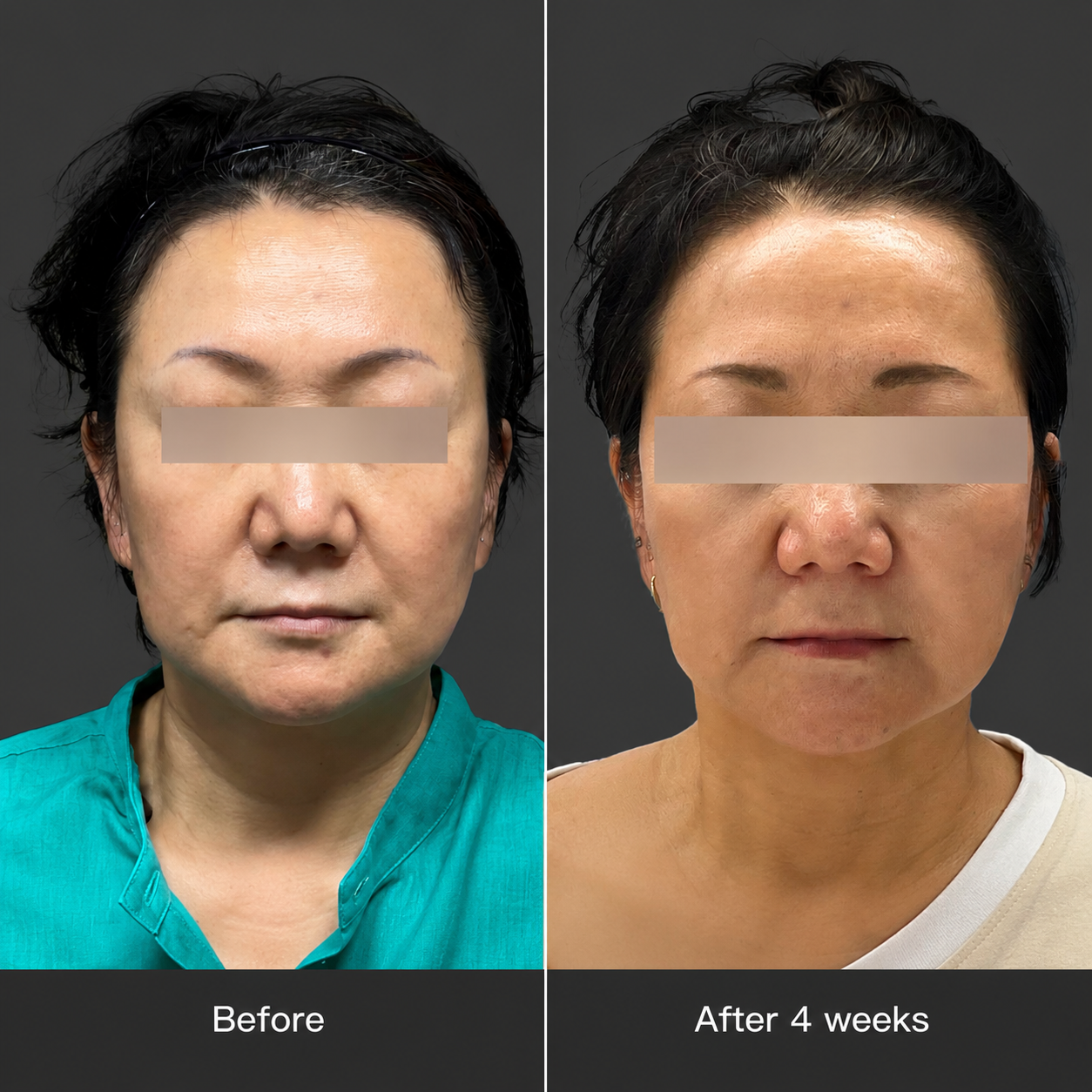 Oligio X clinical result 04