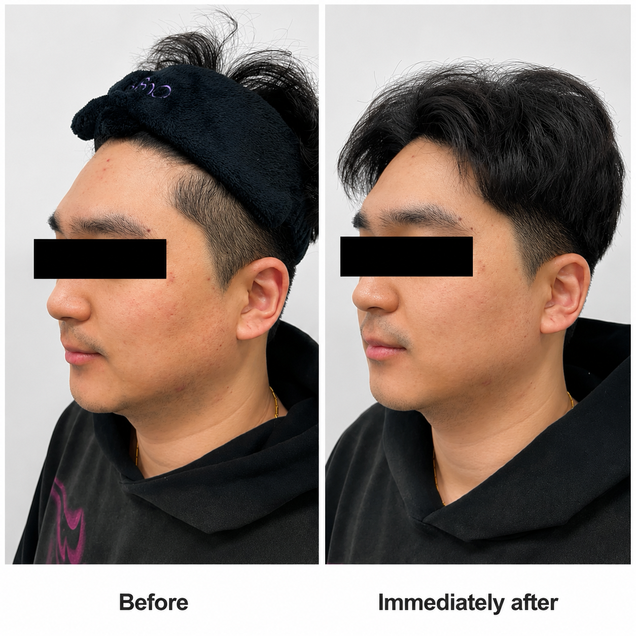 Tightan Pro clinical result 01