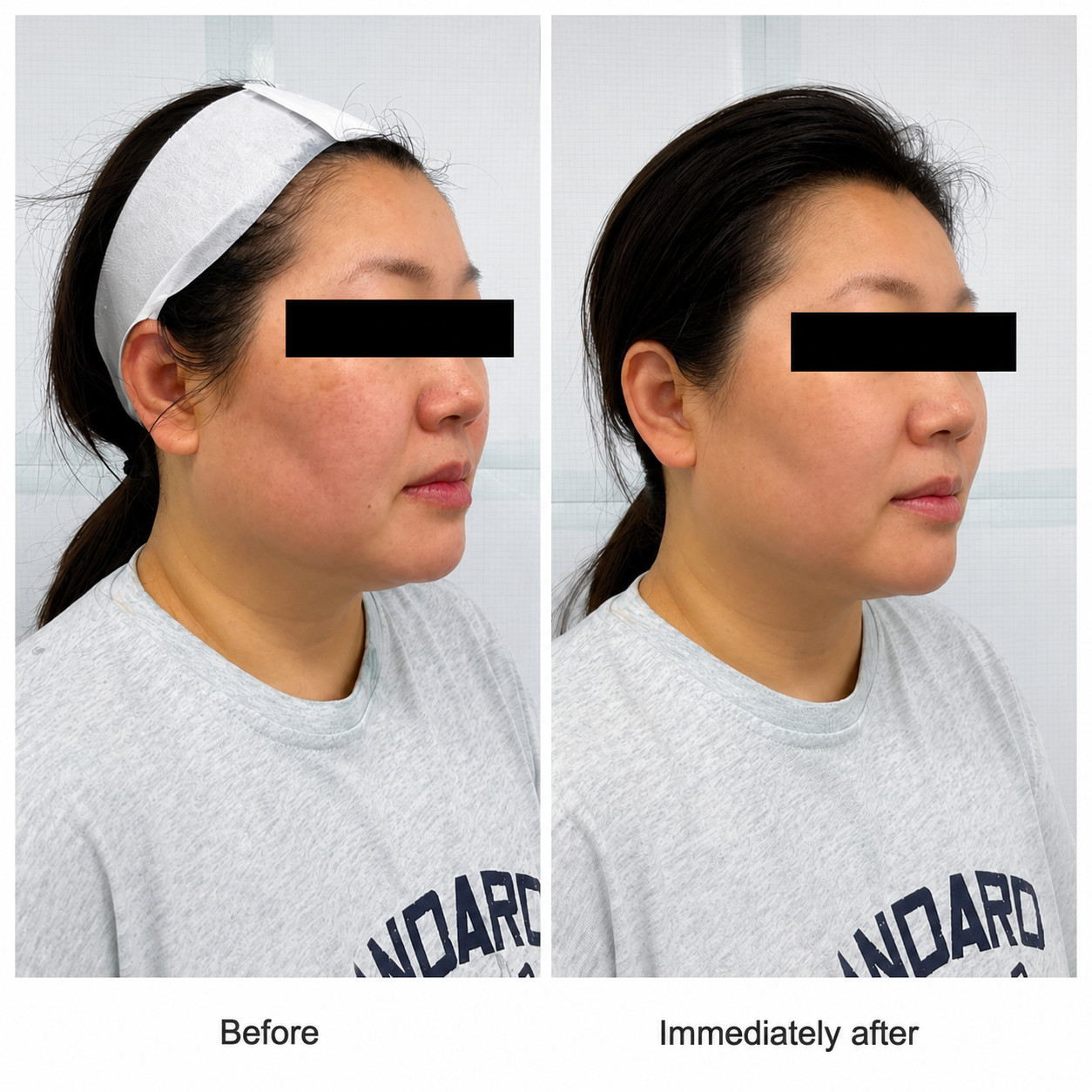 Tightan Pro clinical result 03